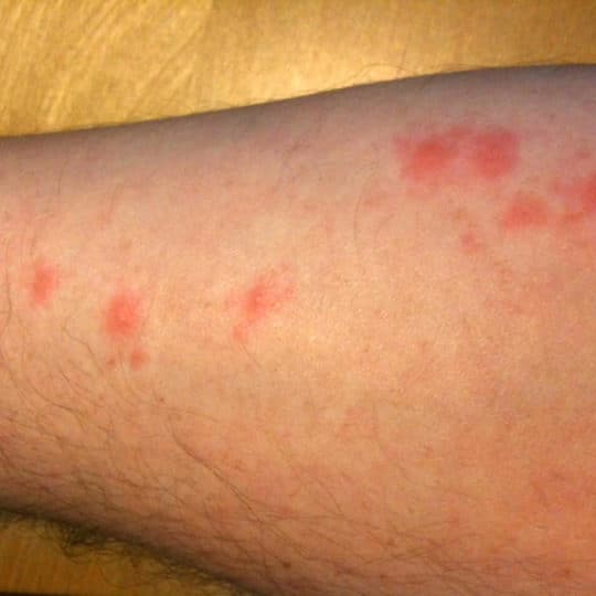Bed Bug Bites