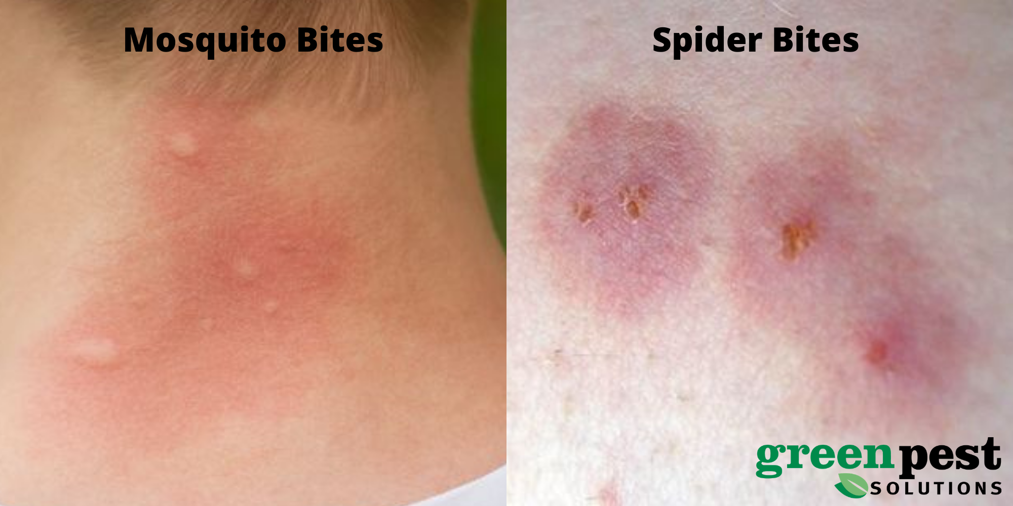 mosquito versus spider bite