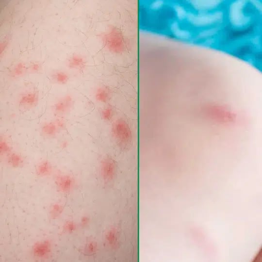 bed bug bite compared to a mosquito bite on the skin