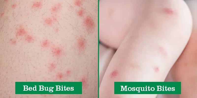 beg bug bites vs mosquito bites