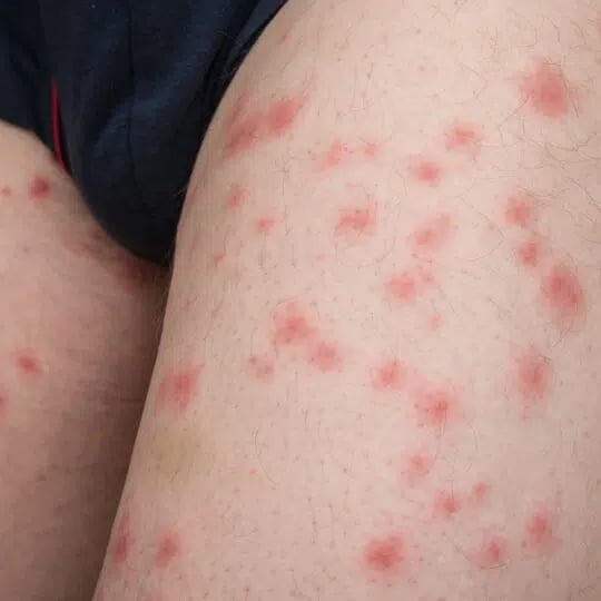 Spider Bite vs Bed Bug Bite