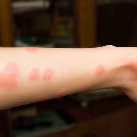 flea-bite