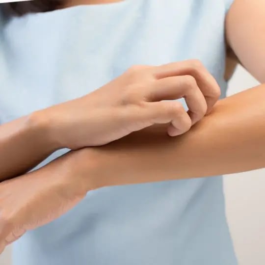 woman itching mosquito bite