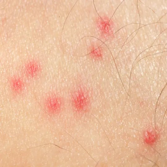mosquito bites